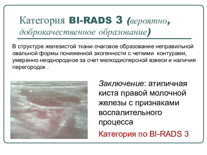 Категория BI-RADS 3 (вероятно, доброкачественное образование) В структуре железистой ткани очаговое образование