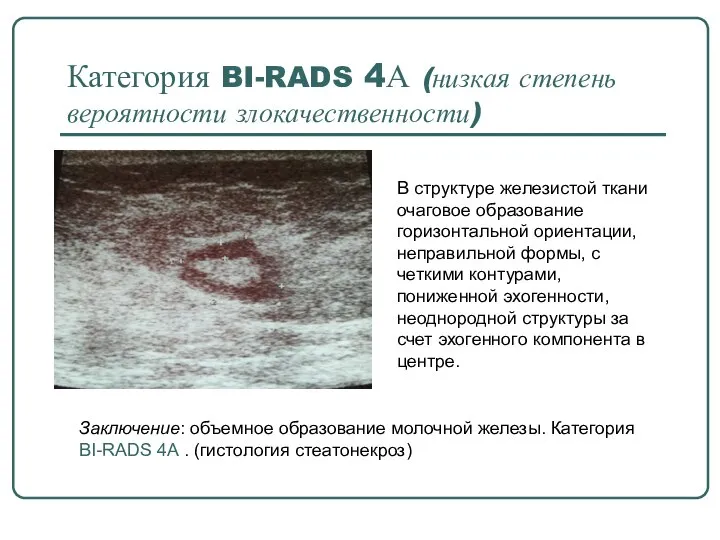 Категория BI-RADS 4А (низкая степень вероятности злокачественности) В структуре железистой ткани очаговое