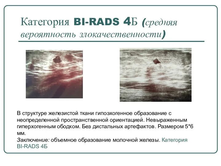 Категория BI-RADS 4Б (средняя вероятность злокачественности) В структуре железистой ткани гипоэхогенное образование