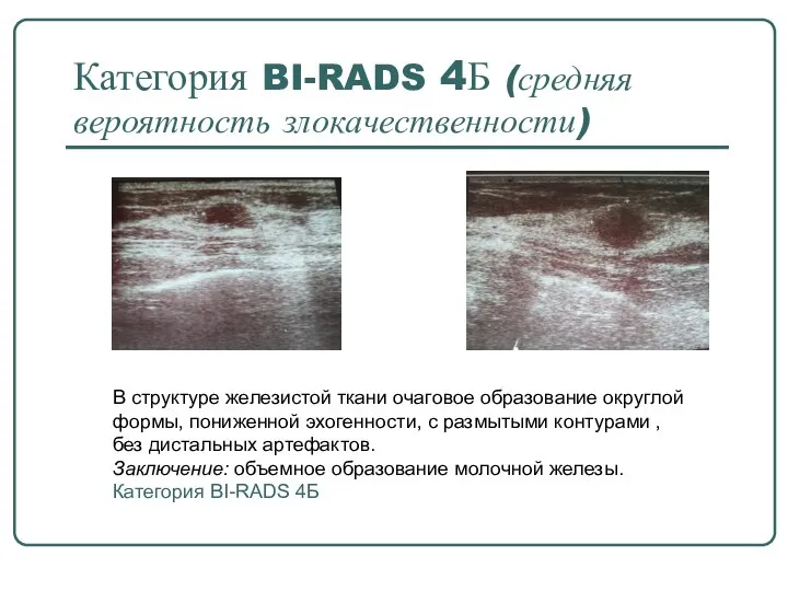 Категория BI-RADS 4Б (средняя вероятность злокачественности) В структуре железистой ткани очаговое образование