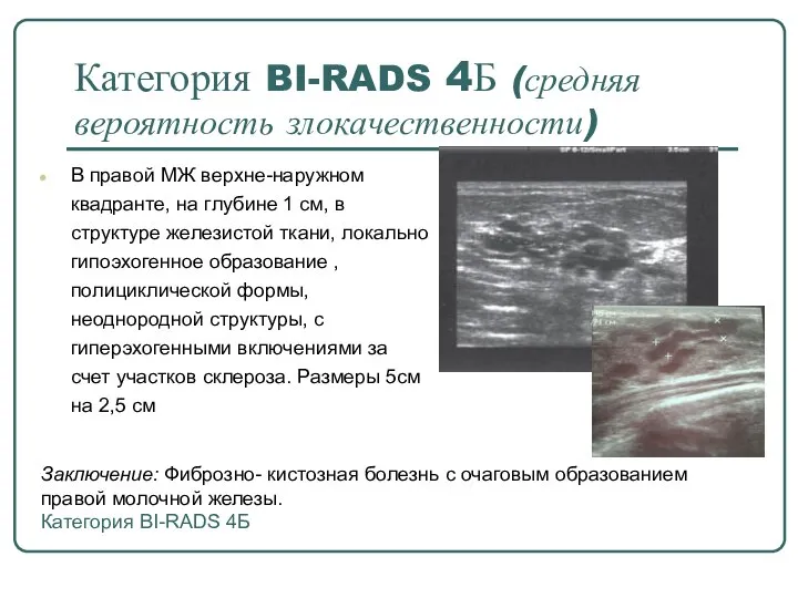 Категория BI-RADS 4Б (средняя вероятность злокачественности) В правой МЖ верхне-наружном квадранте, на