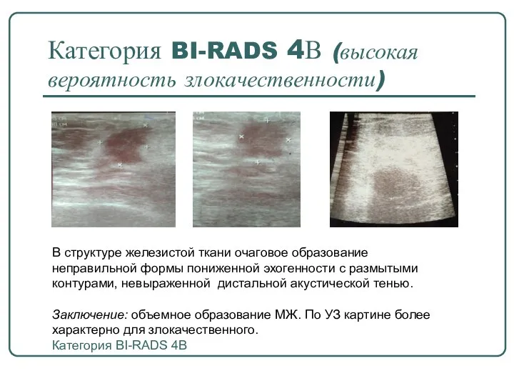 Категория BI-RADS 4В (высокая вероятность злокачественности) В структуре железистой ткани очаговое образование