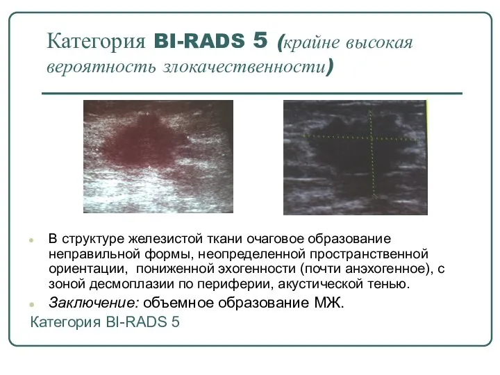 Категория BI-RADS 5 (крайне высокая вероятность злокачественности) В структуре железистой ткани очаговое