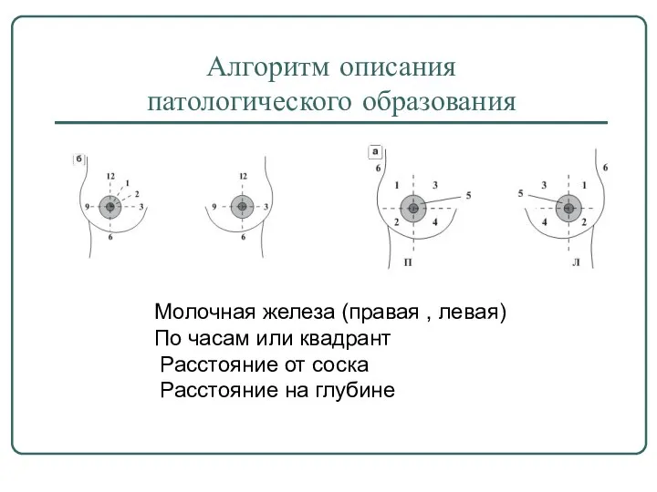 Алгоритм описания патологического образования Молочная железа (правая , левая) По часам или