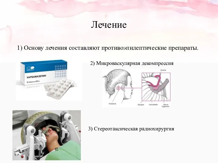 Лечение 1) Основу лечения составляют противоэпилептические препараты. 2) Микроваскулярная декомпрессия 3) Стереотаксическая радиохирургия