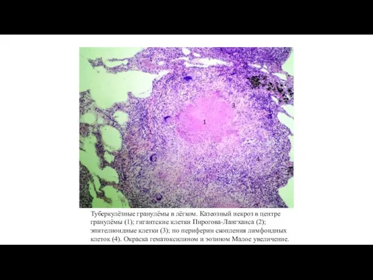 Туберкулёзные гранулёмы в лёгком. Казеозный некроз в центре гранулёмы (1); гигантские клетки