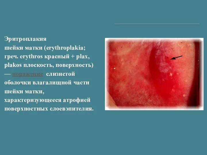 Эритроплакия шейки матки (erythroplakia; греч. erythros красный + plax, plakos плоскость, поверхность)