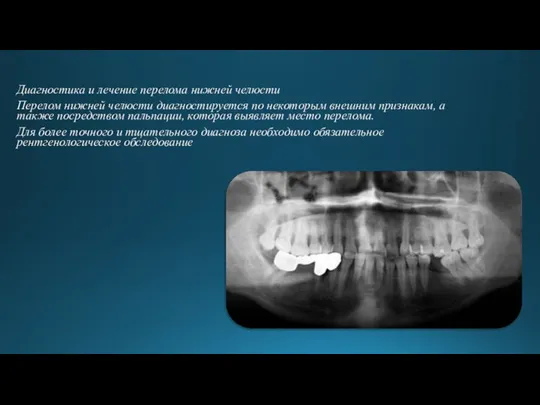 Диагностика и лечение перелома нижней челюсти Перелом нижней челюсти диагностируется по некоторым