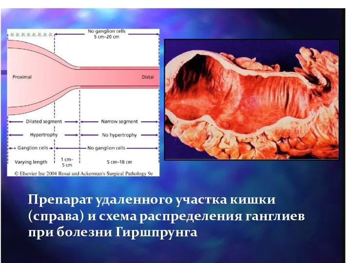 Препарат удаленного участка кишки (справа) и схема распределения ганглиев при болезни Гиршпрунга