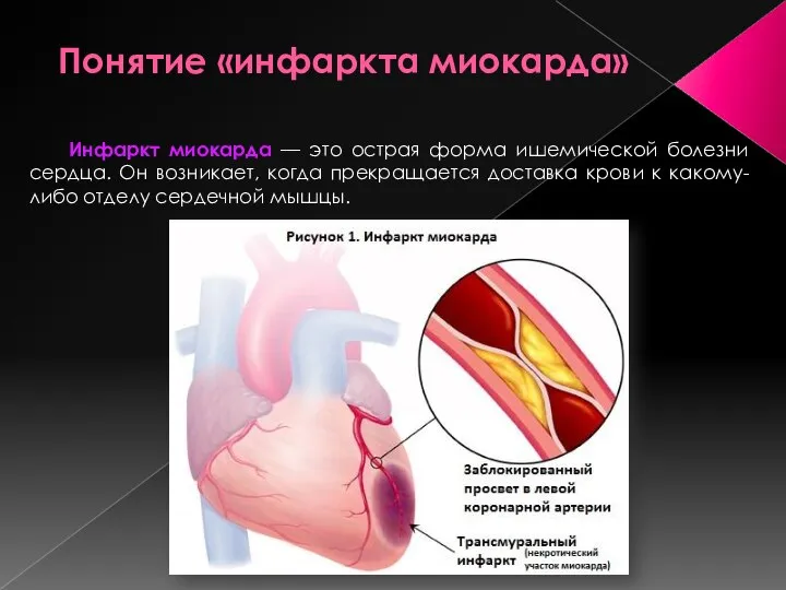 Понятие «инфаркта миокарда» Инфаркт миокарда — это острая форма ишемической болезни сердца.
