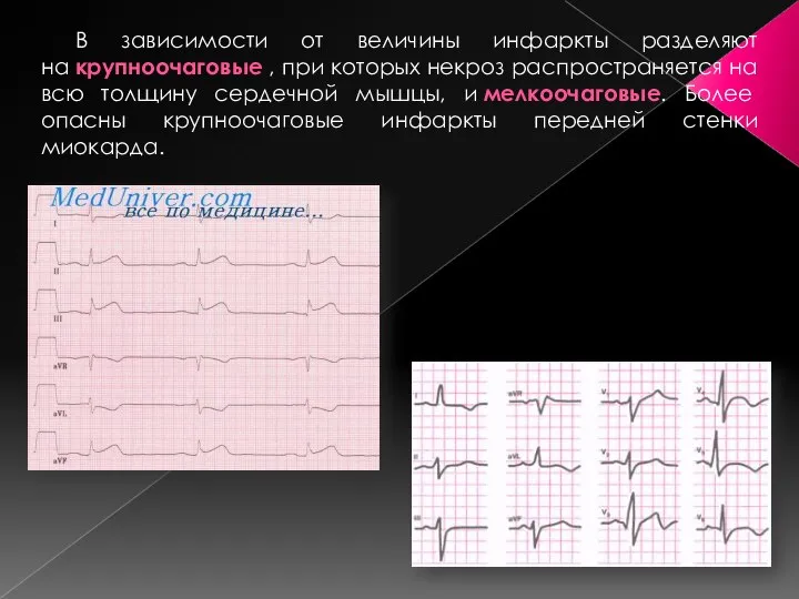 В зависимости от величины инфаркты разделяют на крупноочаговые , при которых некроз