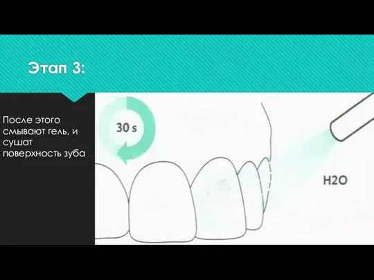 Этап 3: После этого смывают гель, и сушат поверхность зуба
