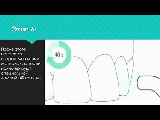 Этап 6: После этого наносится сверхкомпозитный материал, который полимеризуют специальной лампой (40 секунд)