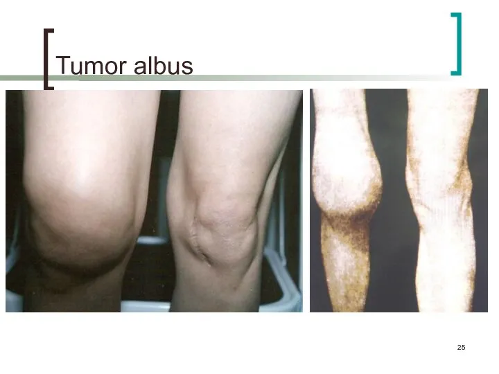 Tumor albus
