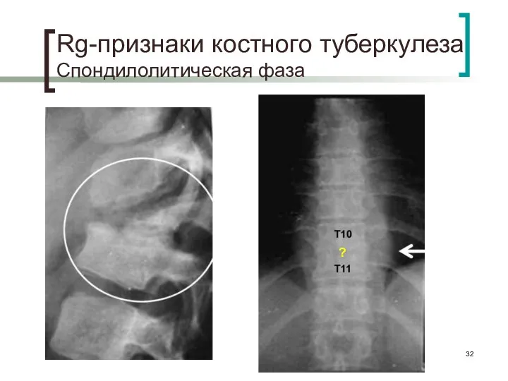 Rg-признаки костного туберкулеза Спондилолитическая фаза ?