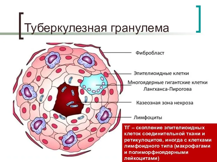 Туберкулезная гранулема ТГ – скопление эпителиоидных клеток соединительной ткани и ретикулоцитов, иногда