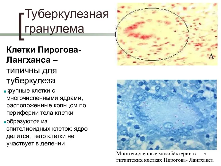 Туберкулезная гранулема Клетки Пирогова-Лангханса – типичны для туберкулеза крупные клетки с многочисленными