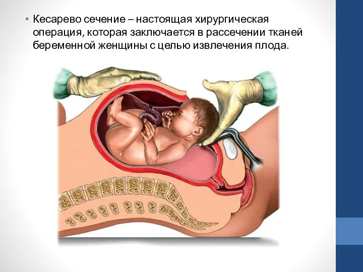 Кесарево сечение – настоящая хирургическая операция, которая заключается в рассечении тканей беременной