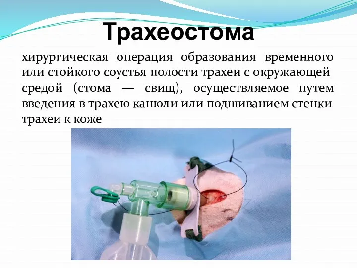 Трахеостома хирургическая операция образования временного или стойкого соустья полости трахеи с окружающей