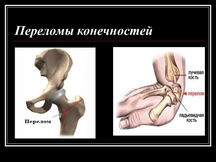 Переломы конечностей