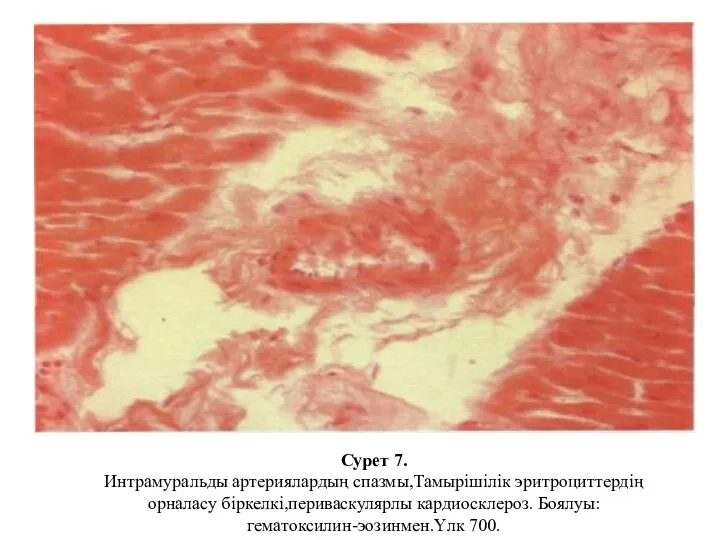 Сурет 7. Интрамуральды артериялардың спазмы,Тамырішілік эритроциттердің орналасу біркелкі,периваскулярлы кардиосклероз. Боялуы: гематоксилин-эозинмен.Үлк 700.