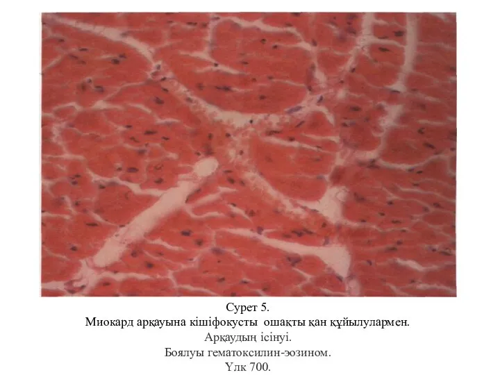 Сурет 5. Миокард арқауына кішіфокусты ошақты қан құйылулармен. Арқаудың ісінуі. Боялуы гематоксилин-эозином. Үлк 700.