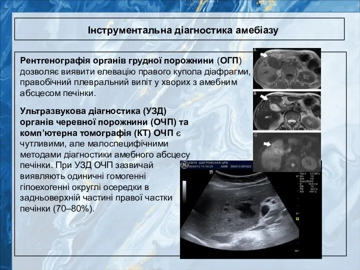 Інструментальна діагностика амебіазу Рентгенографія органів грудної порожнини (ОГП) дозволяє виявити елевацію правого