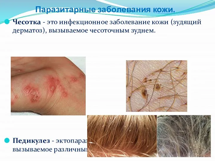 Паразитарные заболевания кожи. Чесотка - это инфекционное заболевание кожи (зудящий дерматоз), вызываемое