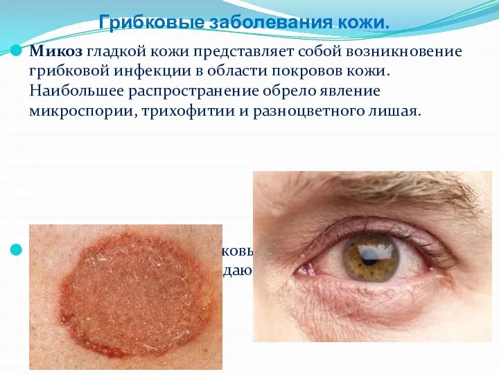 Грибковые заболевания кожи. Микоз гладкой кожи представляет собой возникновение грибковой инфекции в