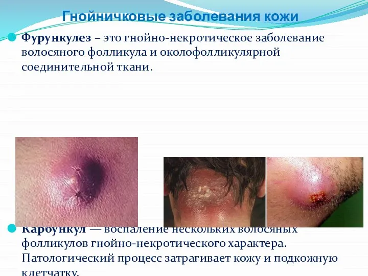 Гнойничковые заболевания кожи Фурункулез – это гнойно-некротическое заболевание волосяного фолликула и околофолликулярной