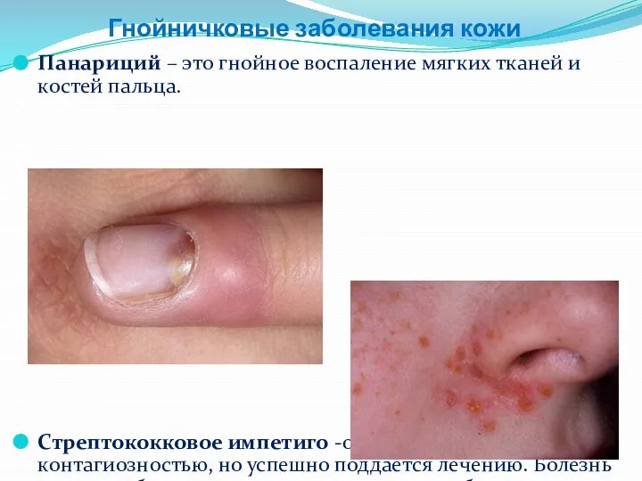 Гнойничковые заболевания кожи Панариций – это гнойное воспаление мягких тканей и костей