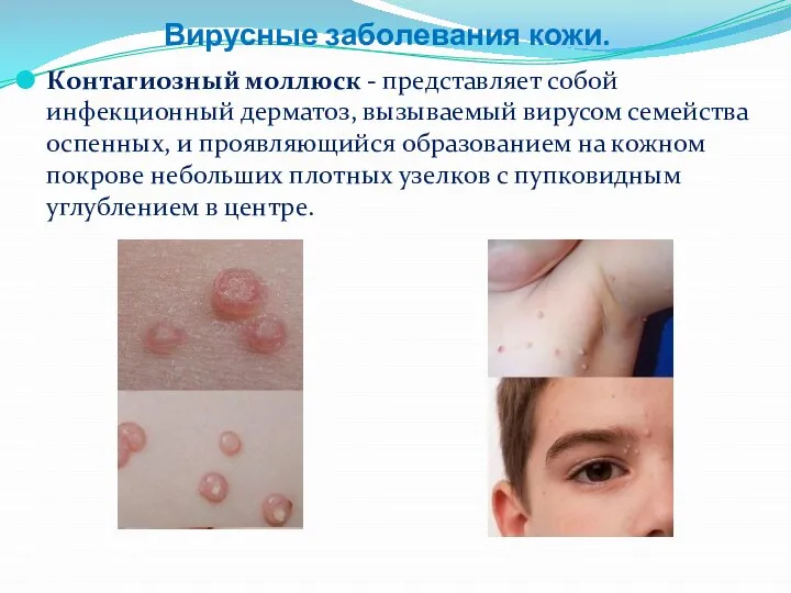 Вирусные заболевания кожи. Контагиозный моллюск - представляет собой инфекционный дерматоз, вызываемый вирусом