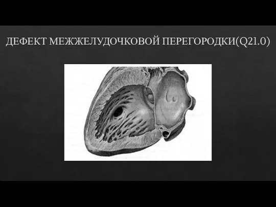 ДЕФЕКТ МЕЖЖЕЛУДОЧКОВОЙ ПЕРЕГОРОДКИ(Q21.0)