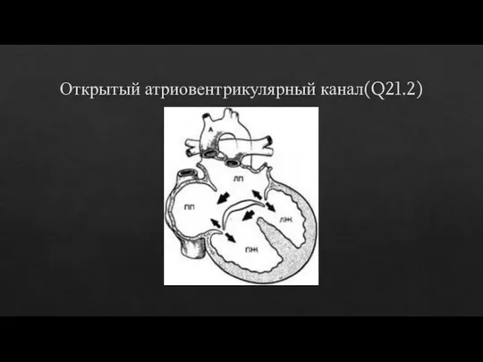 Открытый атриовентрикулярный канал(Q21.2)