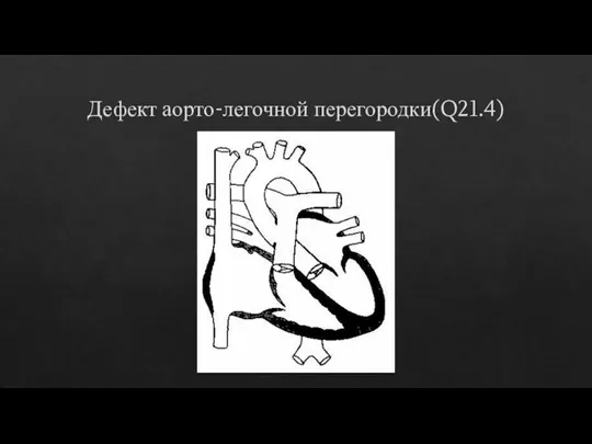 Дефект аорто-легочной перегородки(Q21.4)