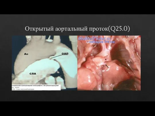 Открытый аортальный проток(Q25.0)