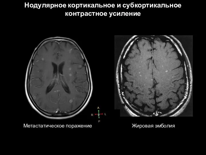 Нодулярное кортикальное и субкортикальное контрастное усиление Метастатическое поражение Жировая эмболия