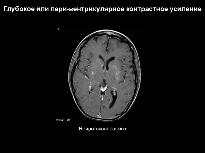 Глубокое или пери-вентрикулярное контрастное усиление Нейротоксоплазмоз