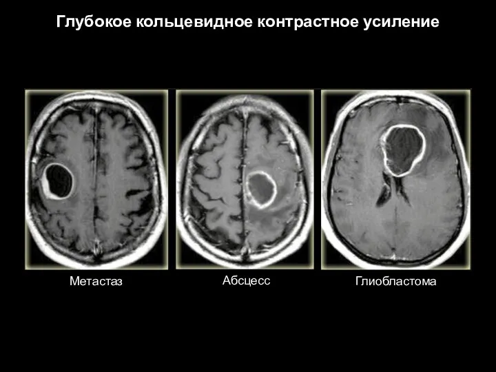 Глубокое кольцевидное контрастное усиление Метастаз Абсцесс Глиобластома