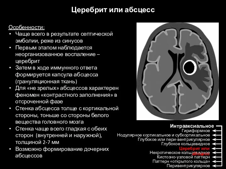 Церебрит или абсцесс Особенности: Чаще всего в результате септической эмболии, реже из