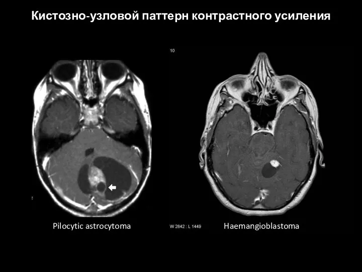 Кистозно-узловой паттерн контрастного усиления Pilocytic astrocytoma Haemangioblastoma