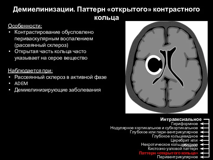 Демиелинизации. Паттерн «открытого» контрастного кольца Особенности: Контрастирование обусловлено периваскулярным воспалением (рассеянный склероз)
