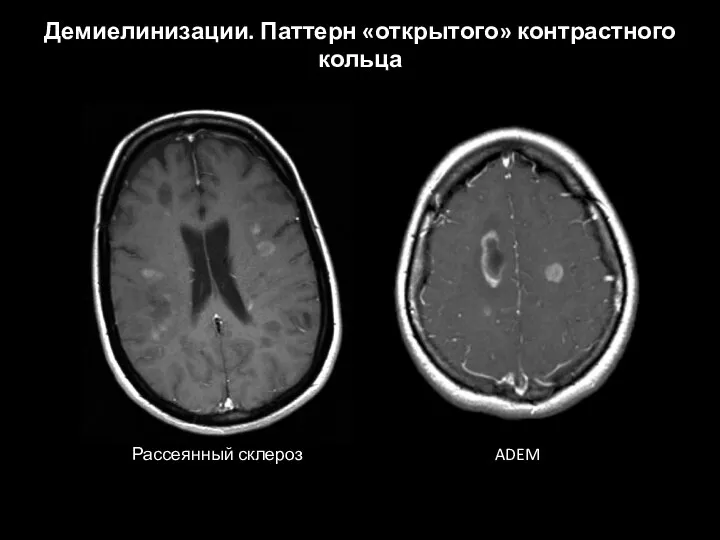 Демиелинизации. Паттерн «открытого» контрастного кольца Рассеянный склероз ADEM