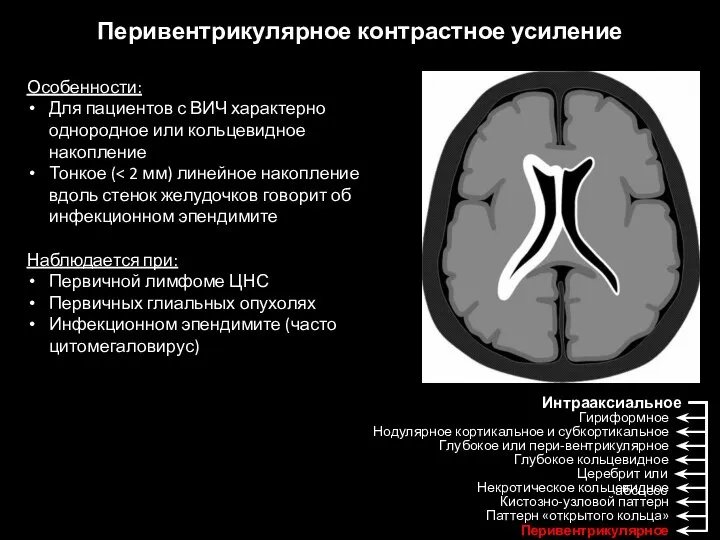 Перивентрикулярное контрастное усиление Особенности: Для пациентов с ВИЧ характерно однородное или кольцевидное