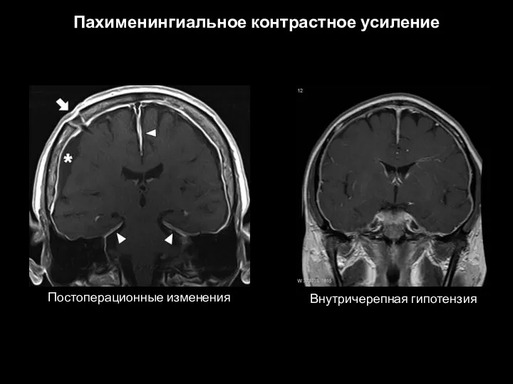 Пахименингиальное контрастное усиление Постоперационные изменения Внутричерепная гипотензия