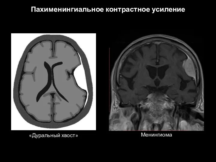 Пахименингиальное контрастное усиление Менингиома «Дуральный хвост»