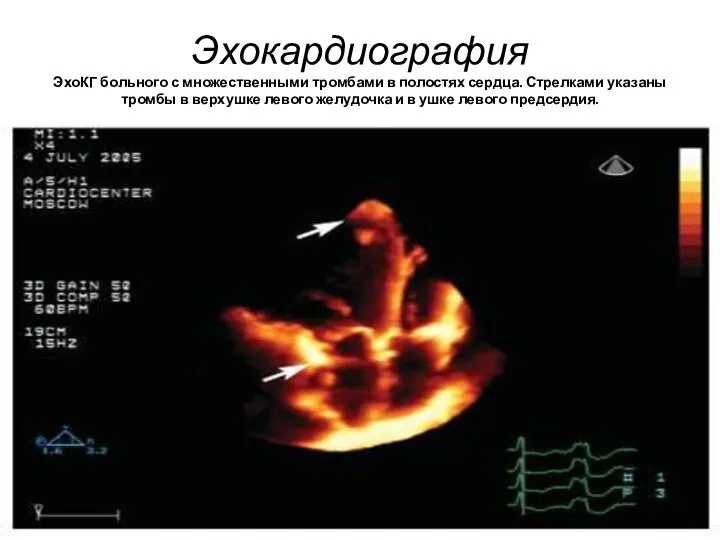 Эхокардиография ЭхоКГ больного с множественными тромбами в полостях сердца. Стрелками указаны тромбы