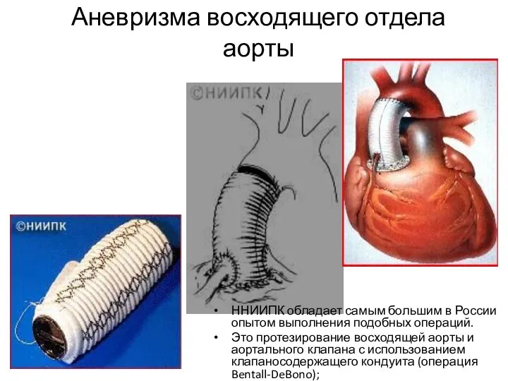 Аневризма восходящего отдела аорты ННИИПК обладает самым большим в России опытом выполнения