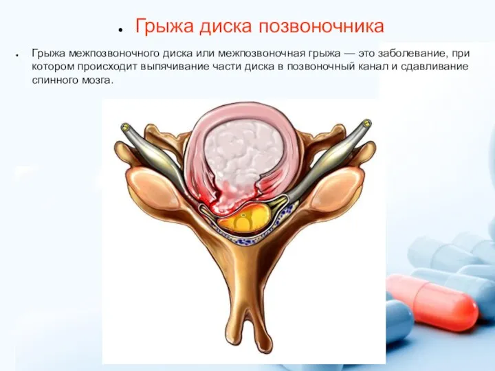 Грыжа диска позвоночника Грыжа межпозвоночного диска или межпозвоночная грыжа — это заболевание,