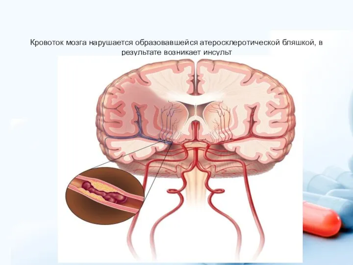 Кровоток мозга нарушается образовавшейся атеросклеротической бляшкой, в результате возникает инсульт